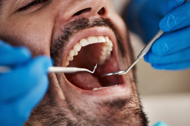 Best Emergency Dentist for Lost Fillings or Crowns in Waunakee, WI